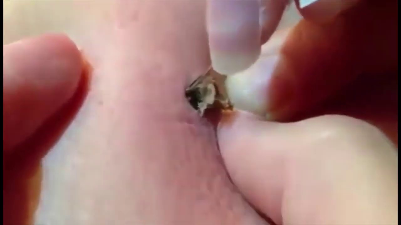 2019 SATISFYING PIMPLE POPPING