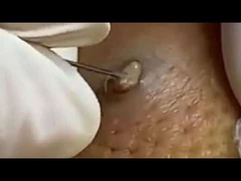 2020 Comedones Popping! Dermatology, Blackheads, Zits and Whiteheads!  Cysts