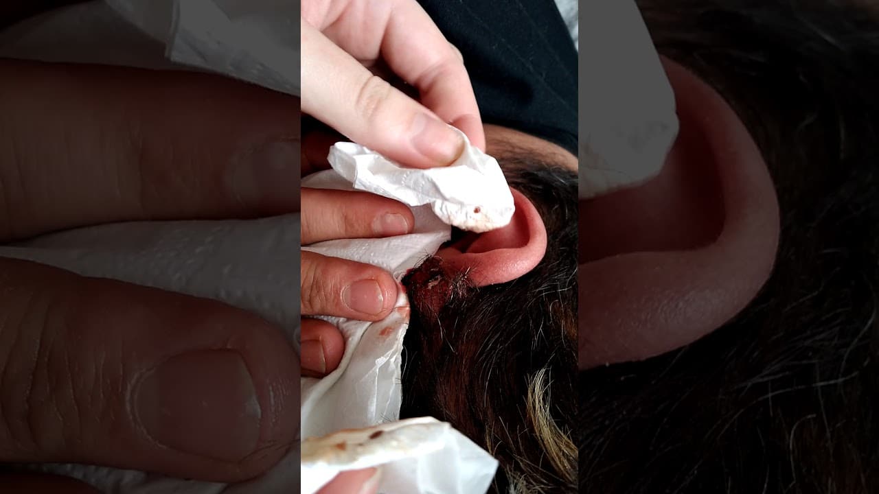 2021   ear cyst zit big explosion.  infected blood pus… scabbed over with hair. screaming pain.