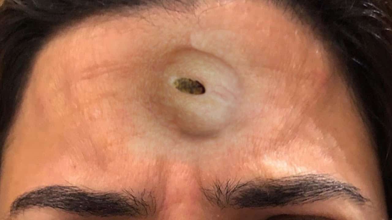 24 Pimple Pops, 3 Epidermoid Cysts and 1 Bit Photoshop Pimple Image