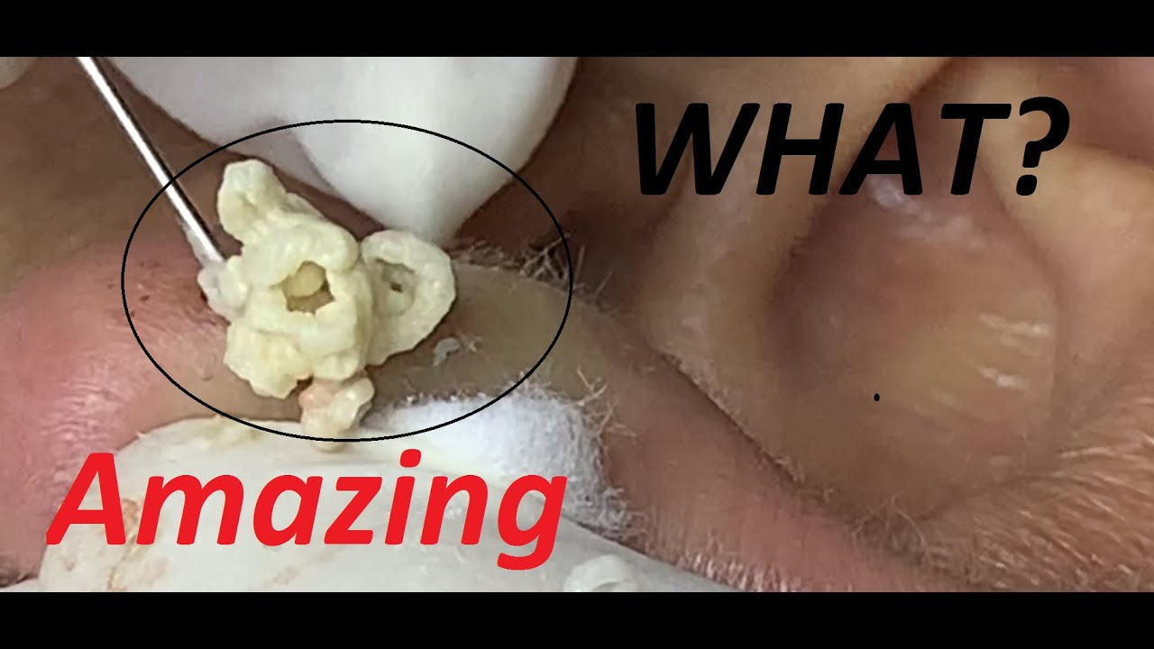 #26 # BIG CYST on the ears. BLACKHEADS and WHITEHEADS for uncle