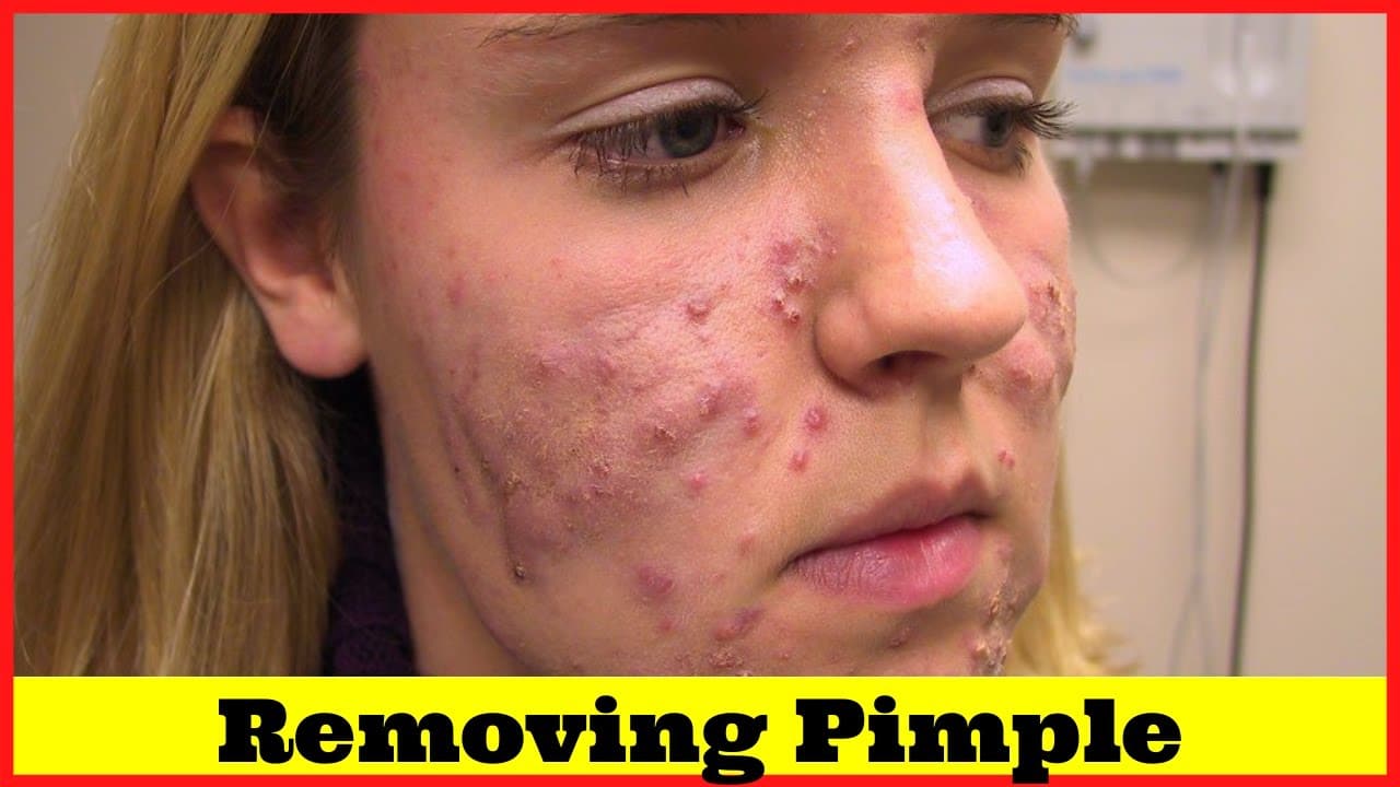 26 – Pimple Popping Compilation Most Popular Sebaceous Cyst Amazing Abscess On Nose of Poor little