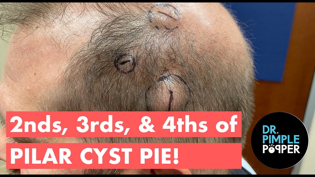 2nds, 3rds, and 4th of Pilar Cyst Pie
