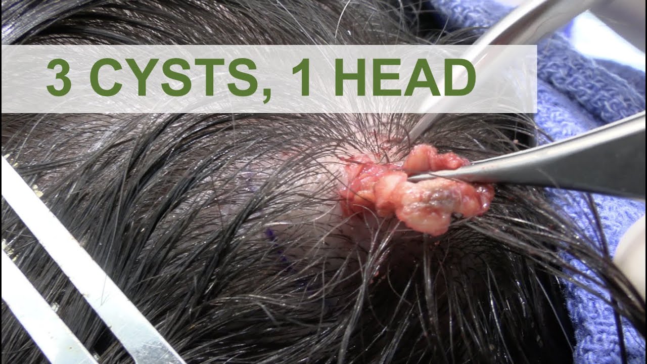 3 Cysts, 1 Head | Dr. Derm