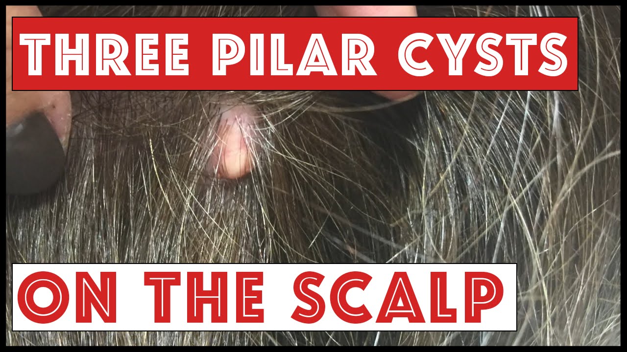 3 Cysts on the Scalp: Pilar Cysts