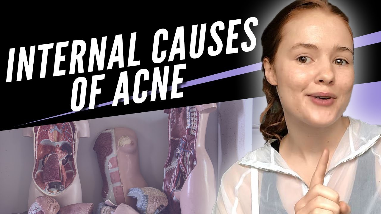 3 Main Causes of Acne