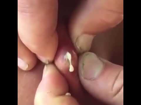 3 pimple popping compilation most popular Sebaceous Cyst Amazing Abscess On Nose of Poor little