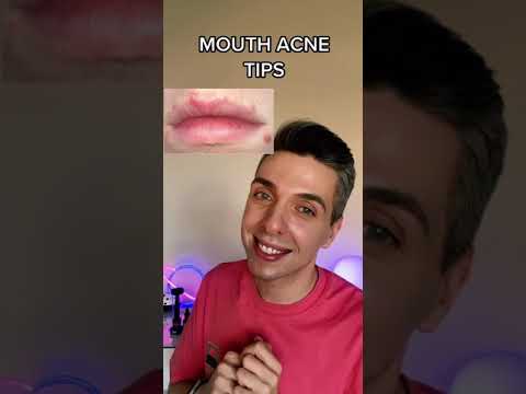 3 Tips for Acne Around Your Mouth #shorts