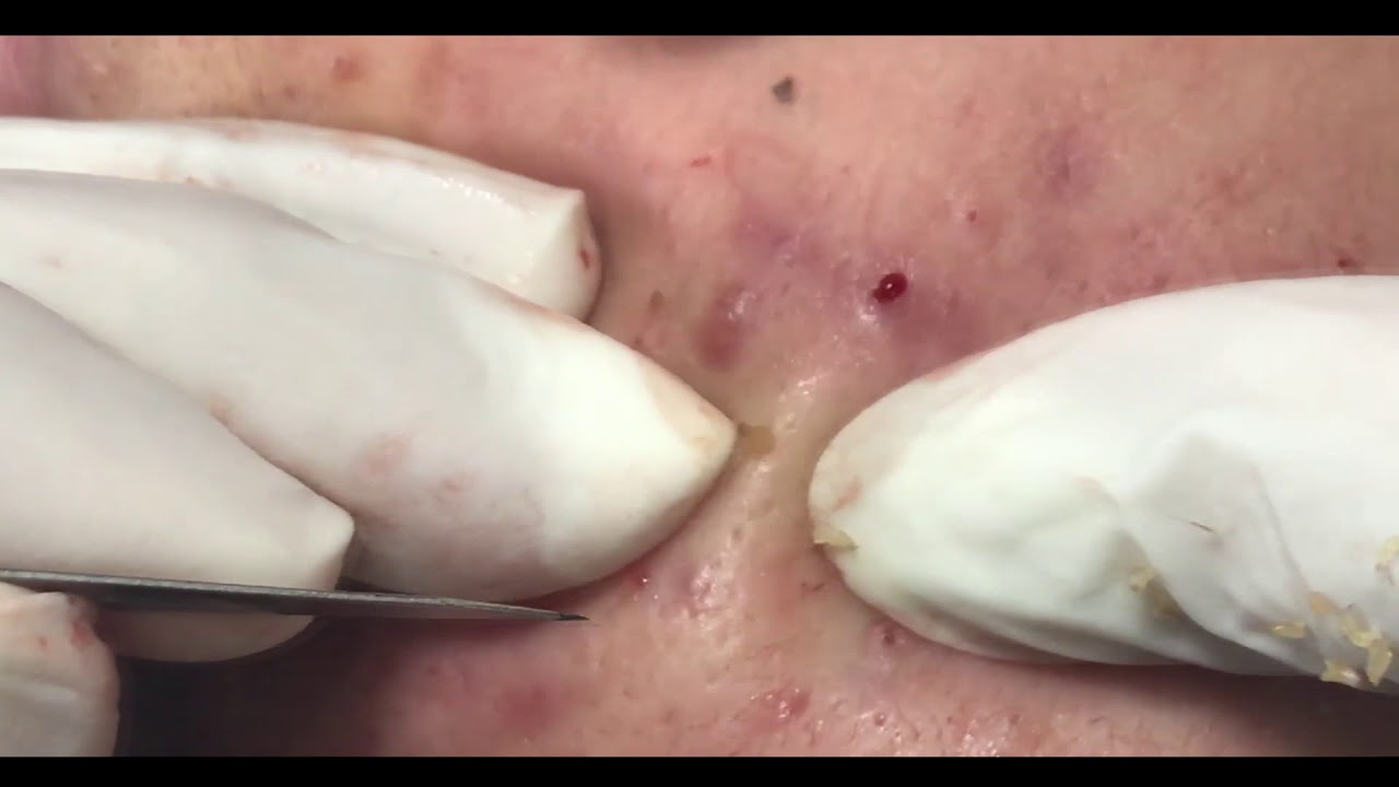 30 MINUTES OF EXTRACTING ACNE!
