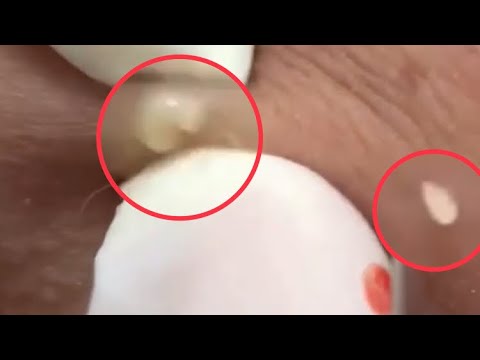 #33#Blackheads Pimples Popping Video Face Cleaning For Client