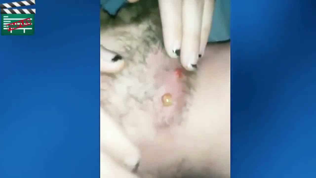 38 Pimple Popping  deep and old cyst and blackhead removals