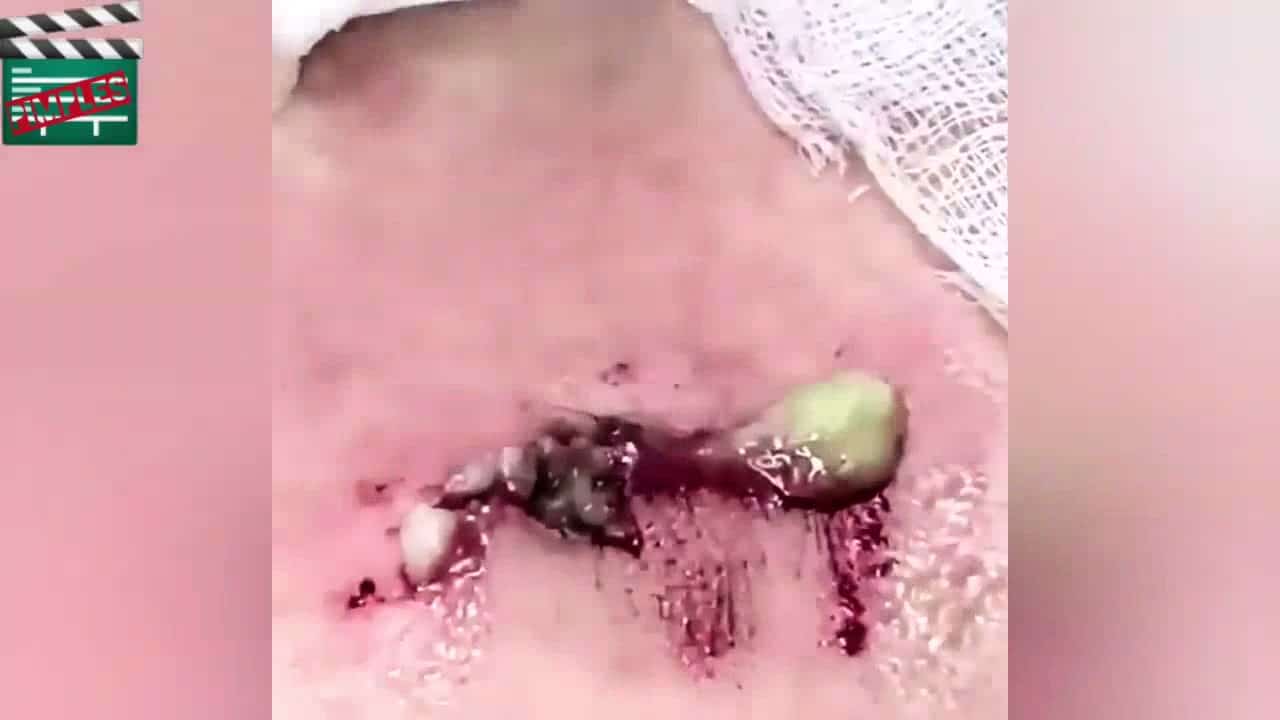 39 Pimple Popping  extremely cyst removals