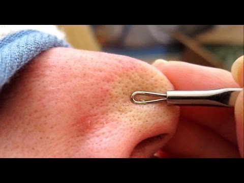 3A of 4 Removing Blackheads & Whiteheads Using A Comedone Extractor Tool HD