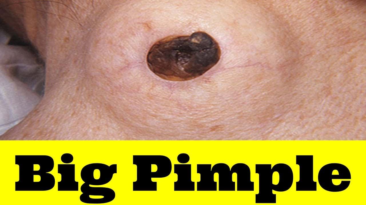 4 – Pimple Popping Compilation Most Popular Sebaceous Cyst Amazing Abscess On Nose of Poor little