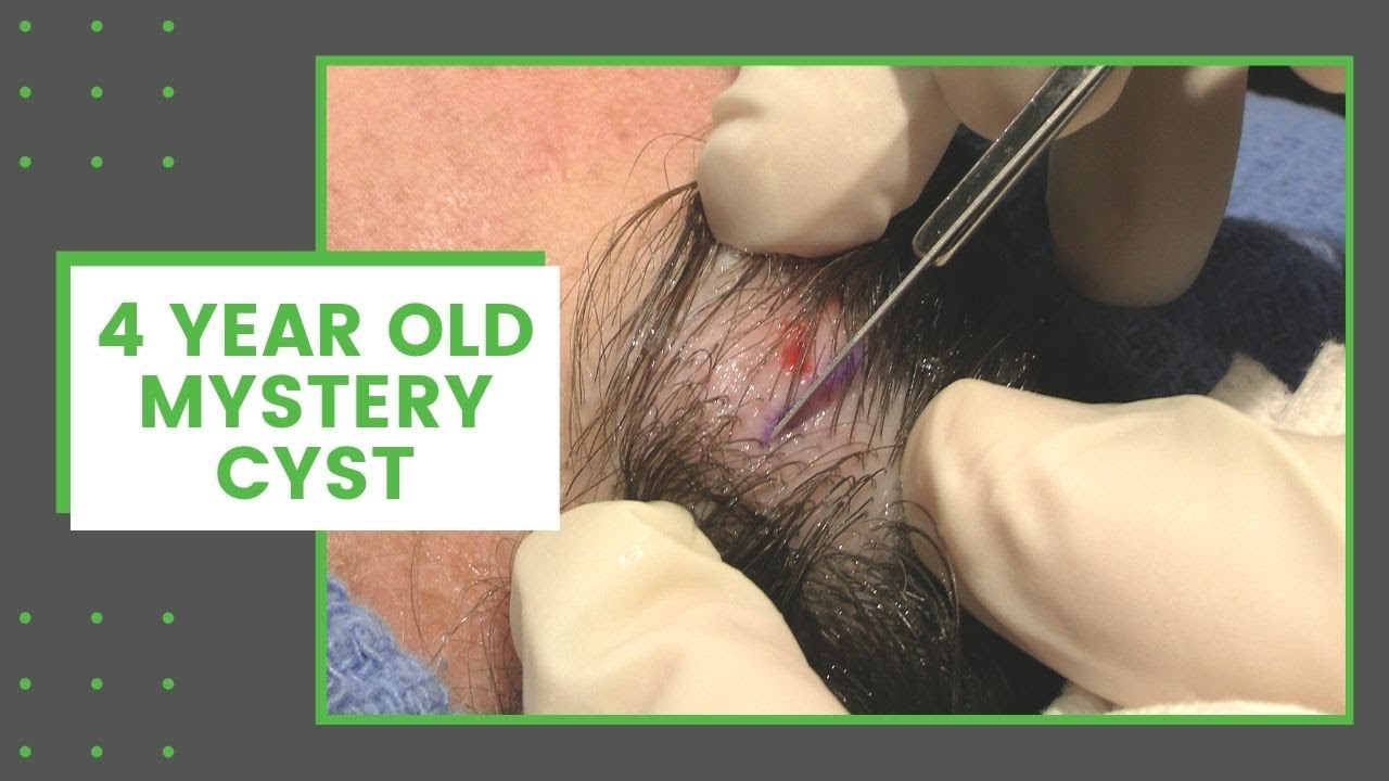 4 Year Old Mystery Cyst | Dr. Derm