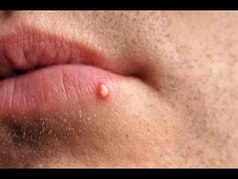 40 SECOND PIMPLE POPPING COMPILATION (SATISFYING!!!!)???