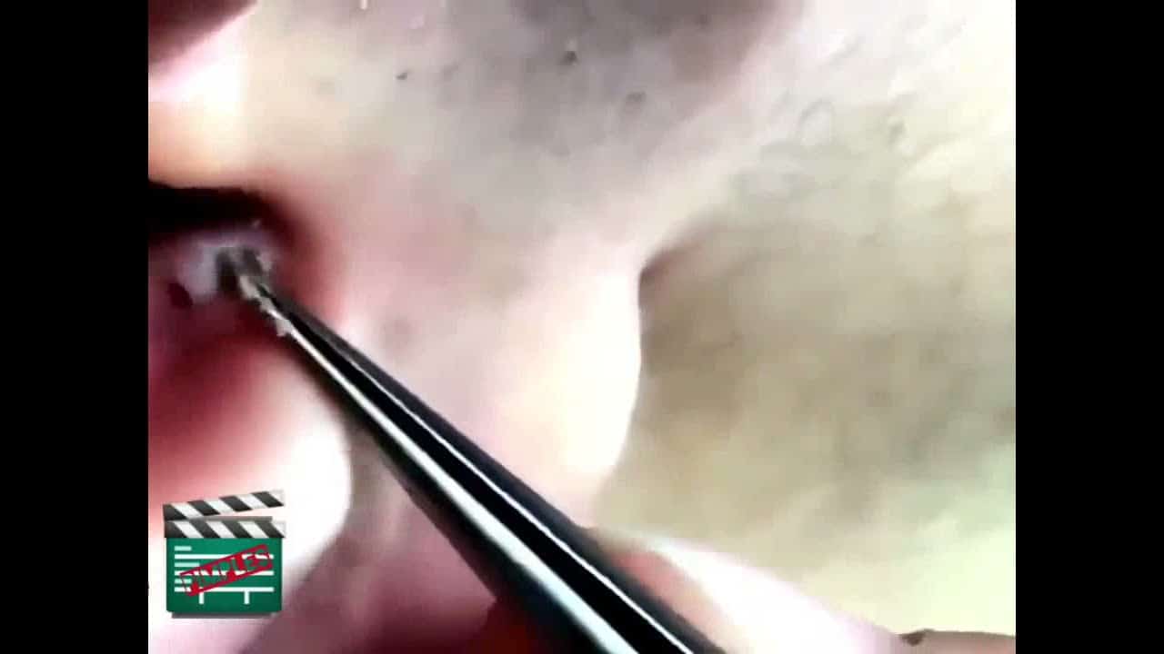42 Pimple Popping  biggest and oldest blackhead in ear satisfying removal
