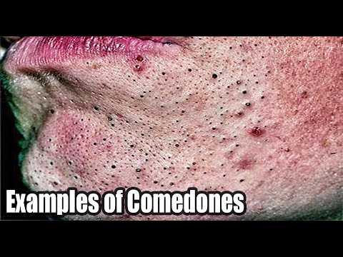 43 Comedones Extracted!  Nose, Chin and Forehead Blackheads!  Pimple Popping