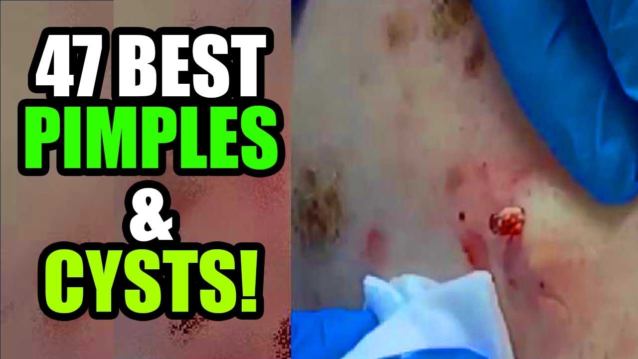 47 Big Blackheads, Cysts, Pimples and Whitehead Pops!  Acne, Zits & Popping