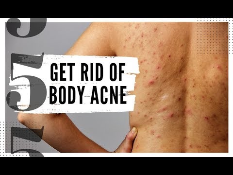 5 At Home Tips to Get Rid of Body Acne Fast