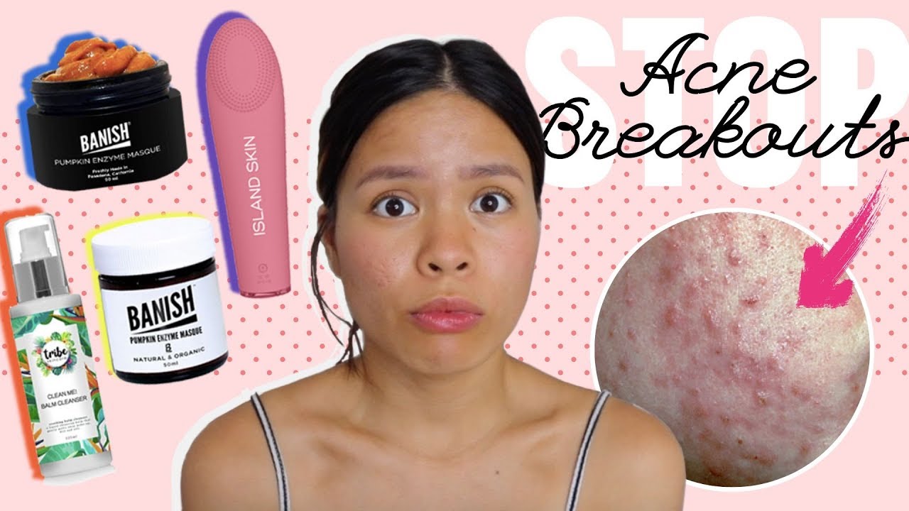 5 Mistakes that Make your Acne Worse