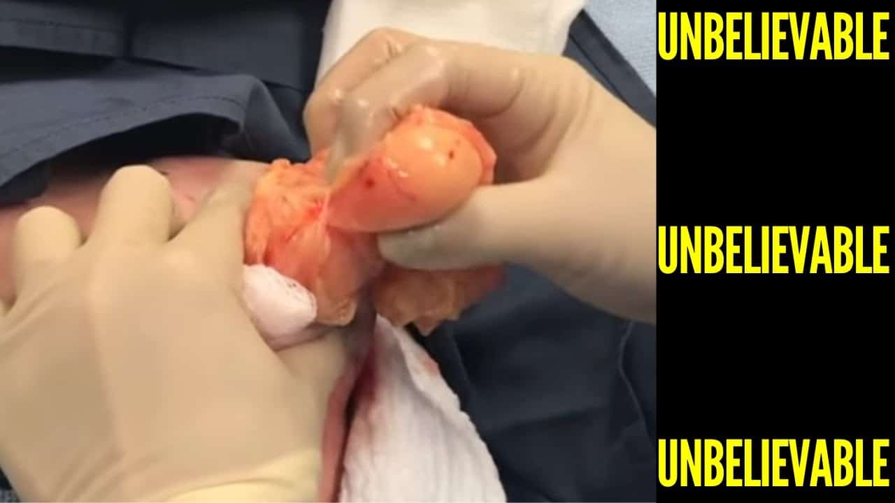 5 – Pimple Popping Compilation Most Popular Sebaceous Cyst Amazing Abscess On Nose of Poor little