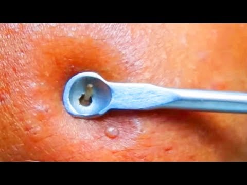 5 Pimples, Blackheads, Zits and Cysts!