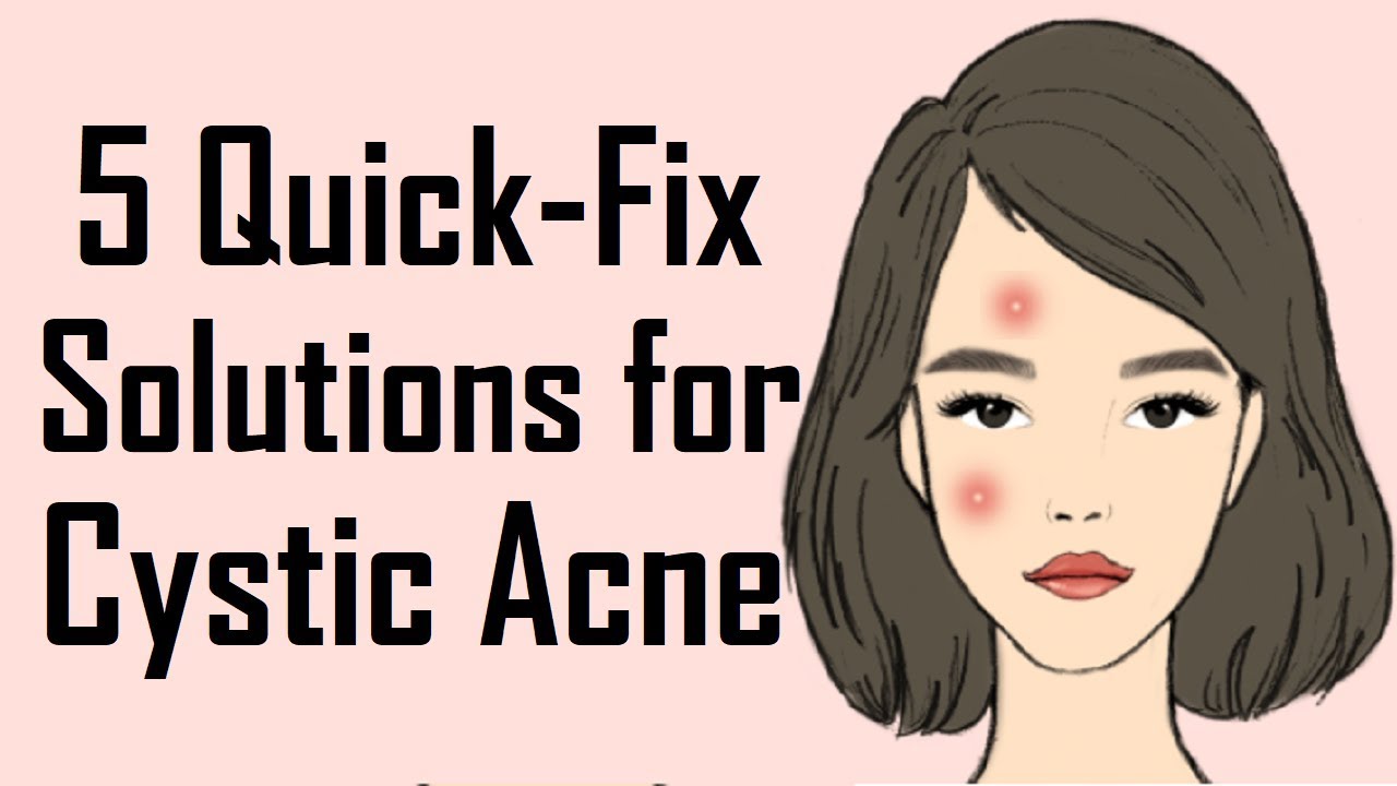 5 Remedies to get rid of Cystic Acne | How to get rid of Cystic Acne