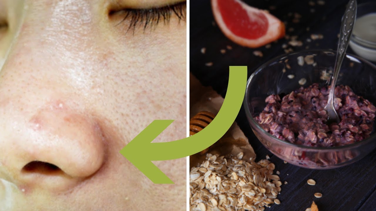 5 Whiteheads on Nose Removal Home Remedies – Whiteheads Removal Hack Nose