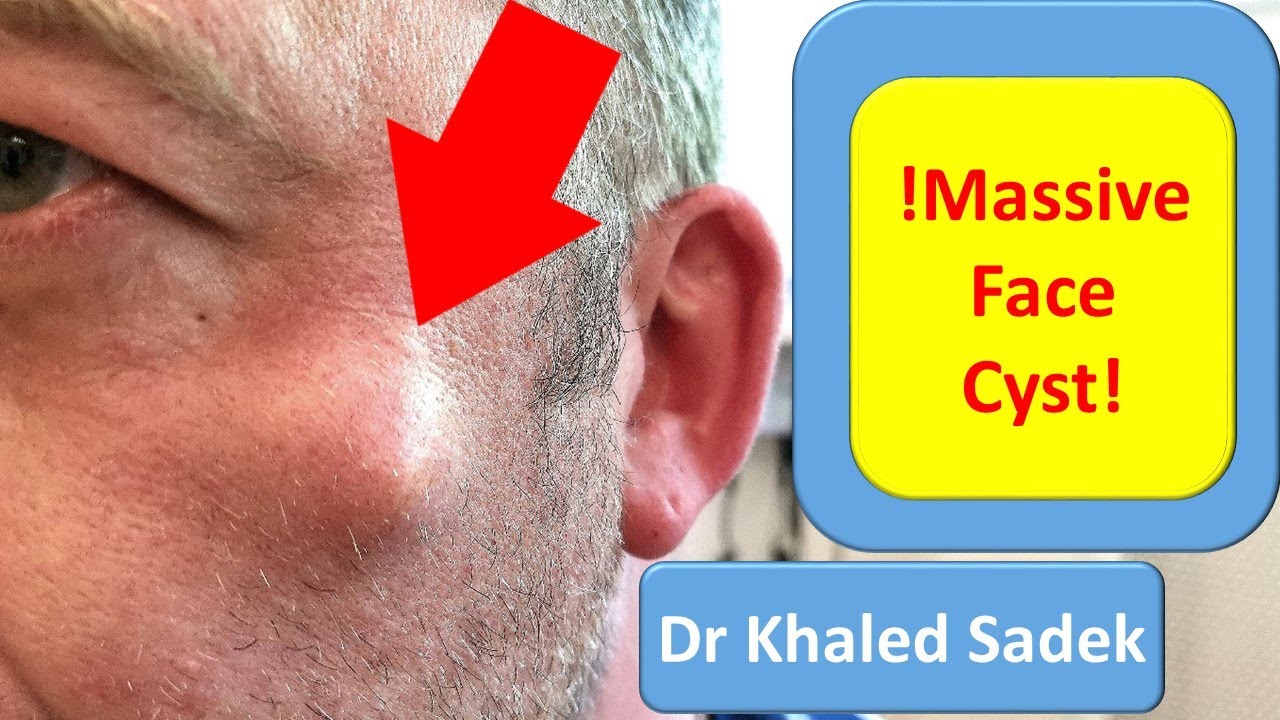 5 year Face Cyst. Cyst Removal Clinic London. Dr Khaled Sadek