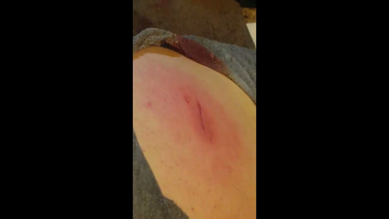5 year old cyst POPPED!