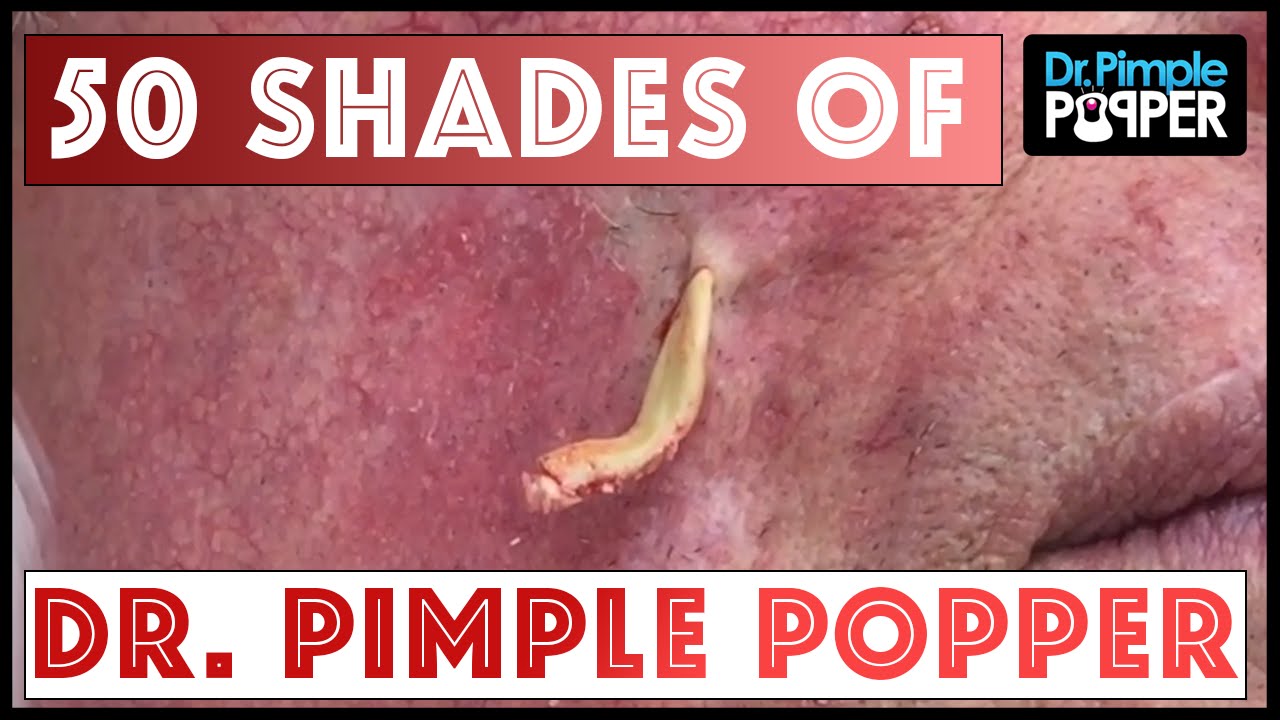 50 shades of DrPimplePopper: A 1 Million Subs Special
