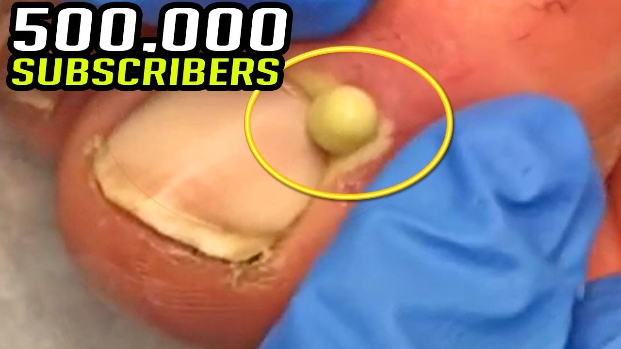 500,000 Cysts, Blackheads & Ingrown Nails!  Thank You Video!