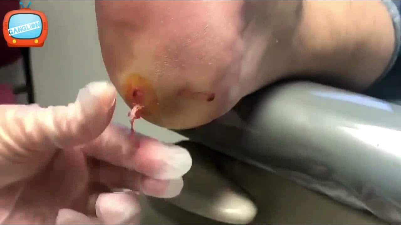 51 Pimple Popping  cyst popping satisfying removal on foot