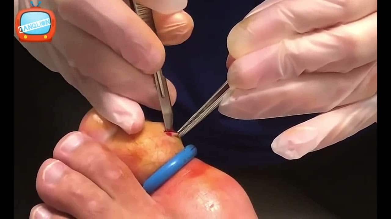 52 Pimple Popping  extra big cyst removal on toe