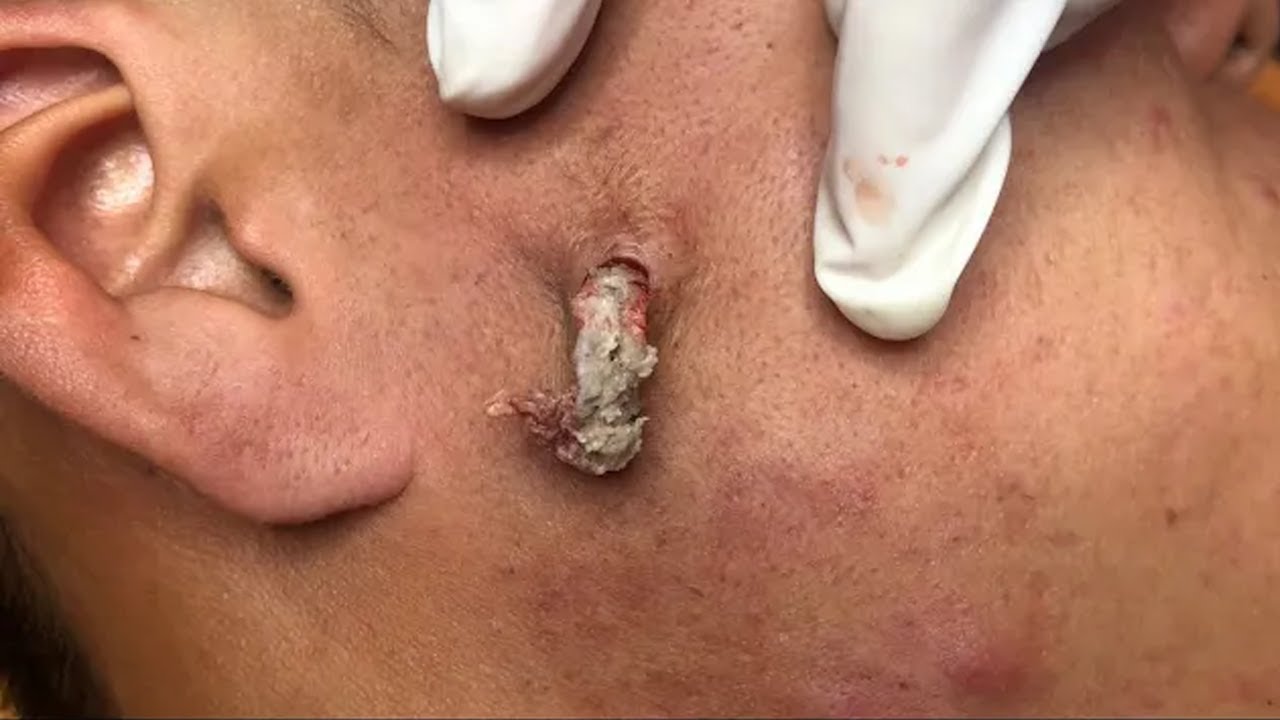 (59) CYST IN THE CHEEK | Windy Spa