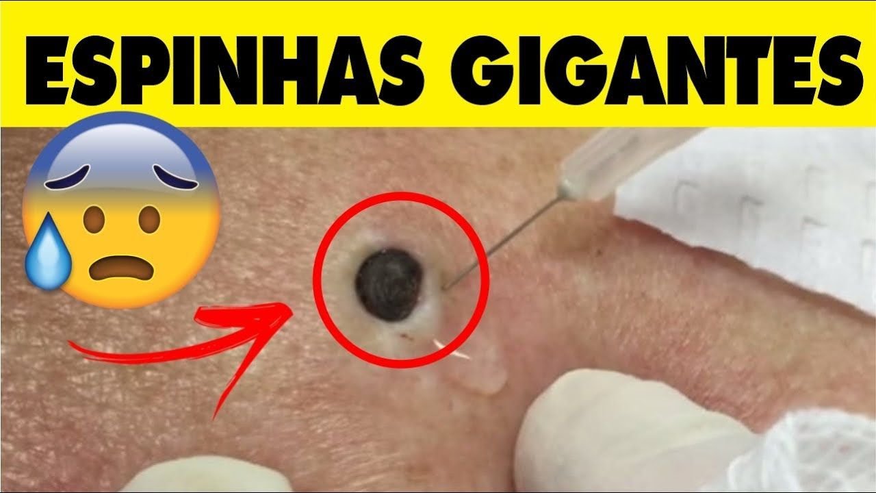 6 – Pimple Popping Compilation Most Popular Sebaceous Cyst Amazing Abscess On Nose of Poor little