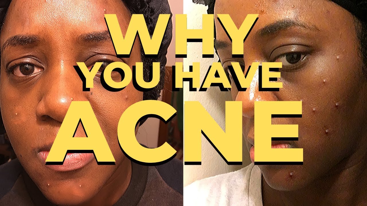 6 Sneaky Reasons Why You Have Acne (Acne Treatment, Oily Skin, Acne Removal)