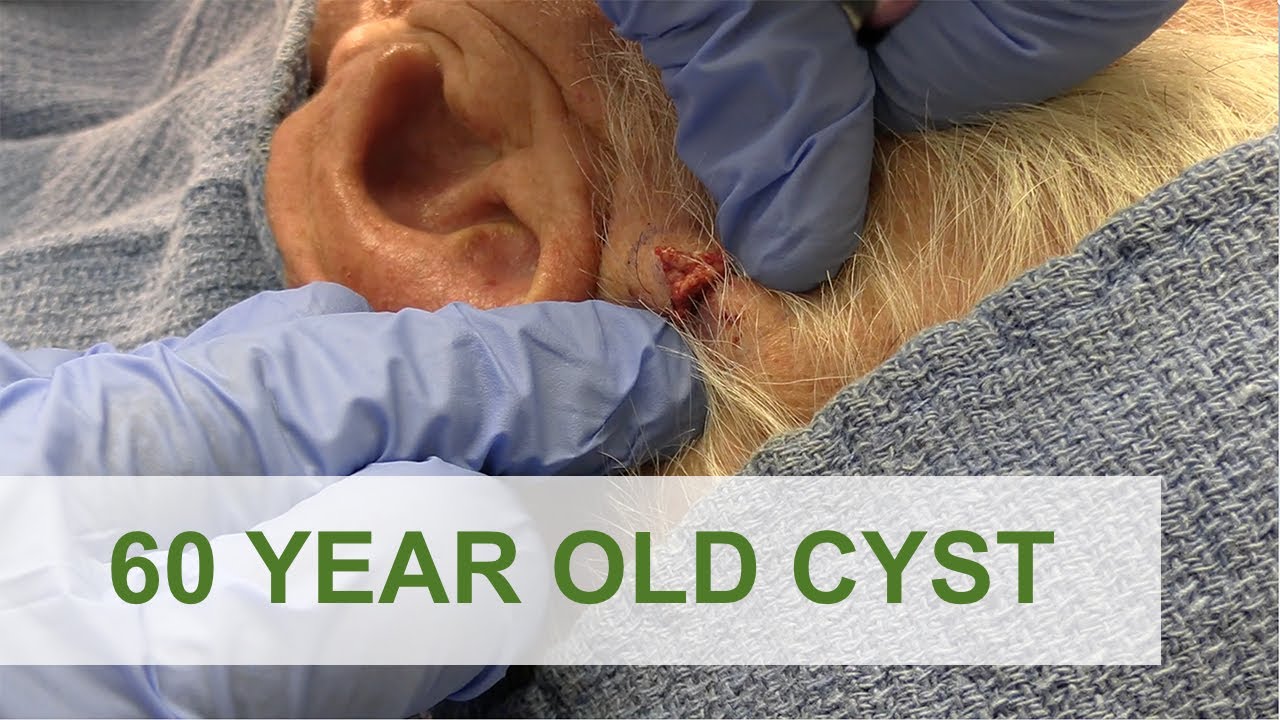 60 Year Old Cyst Born in Santiago | Dr. Derm