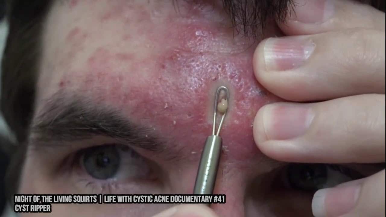 666 Pimples, Cysts, Blackheads and Comedones.  Pimple Popping Fever