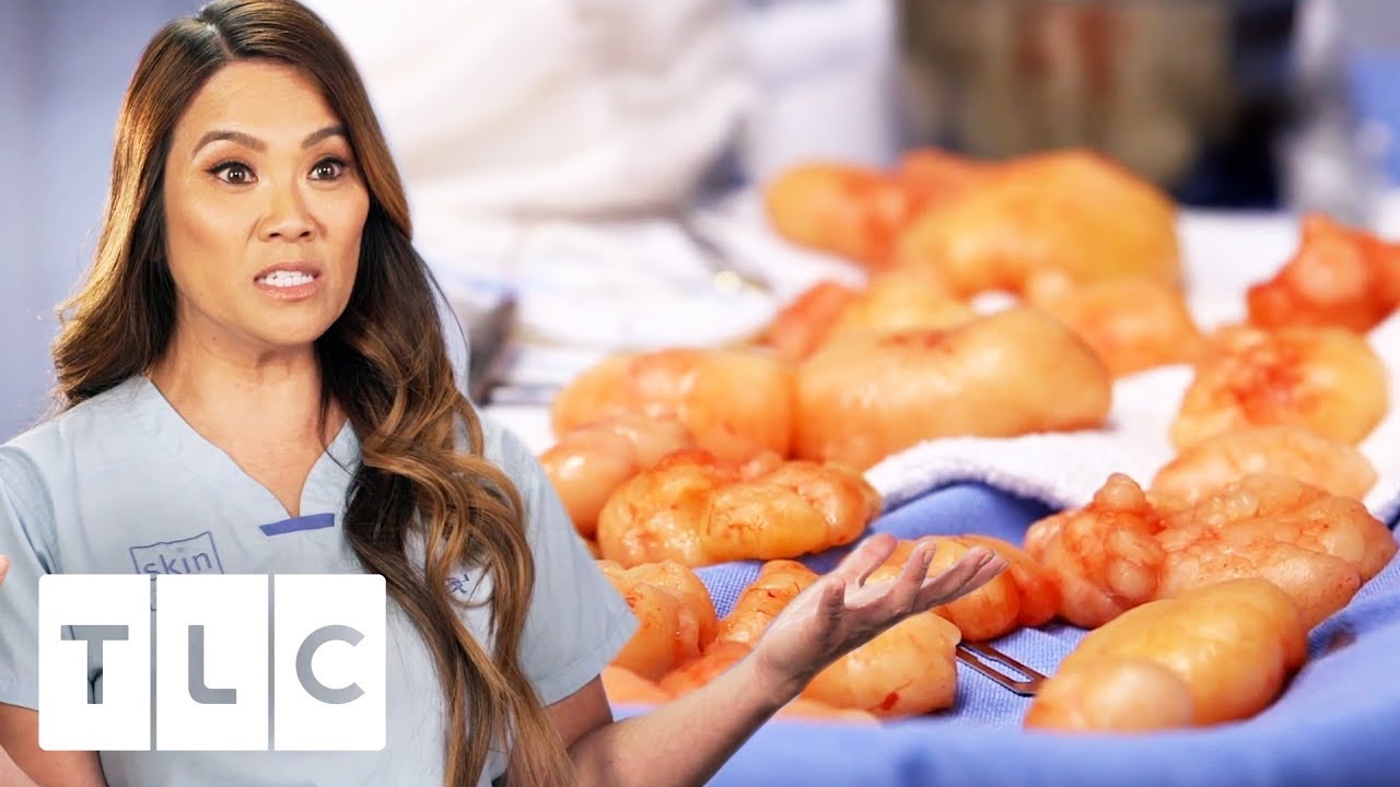 68 Lipomas Removed From a Patient's Arms! | Dr. Pimple Popper