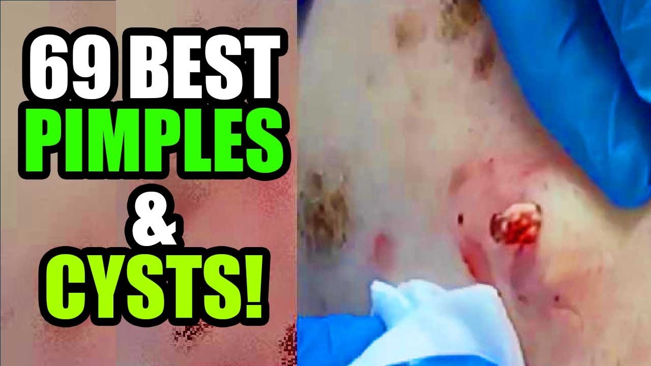 69 Pimples?  Big Pops, Blackheads, Wart Removal and Cyst Popping