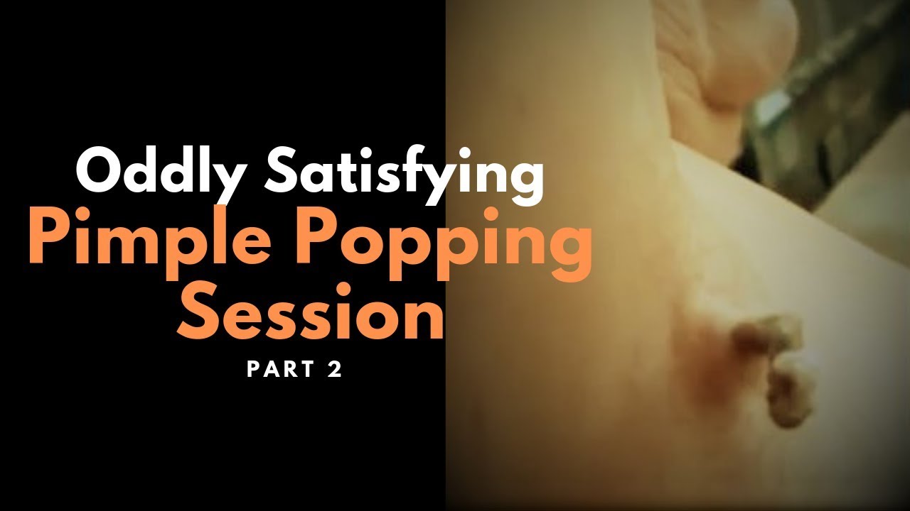7 Oddly Satisfying Pimple Popping Session #2