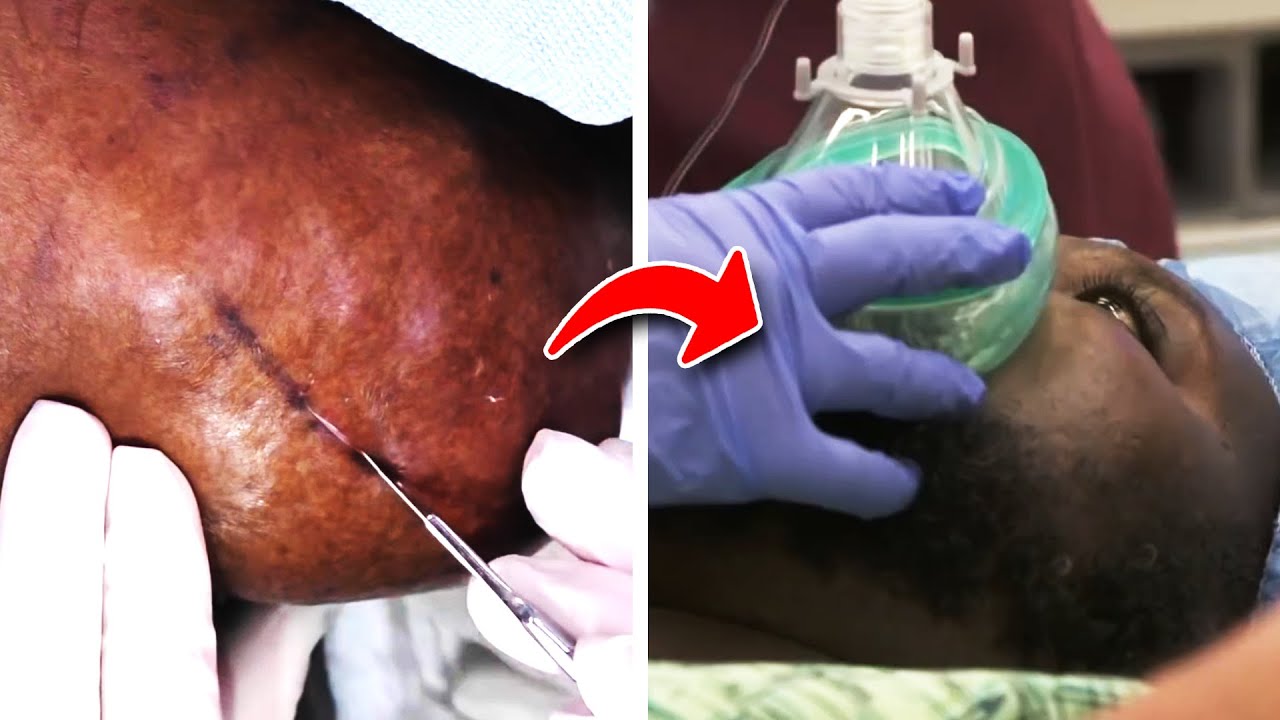 7 Of The Most INSANE Dr. Pimple Popper Pops of 2021 (SO FAR)