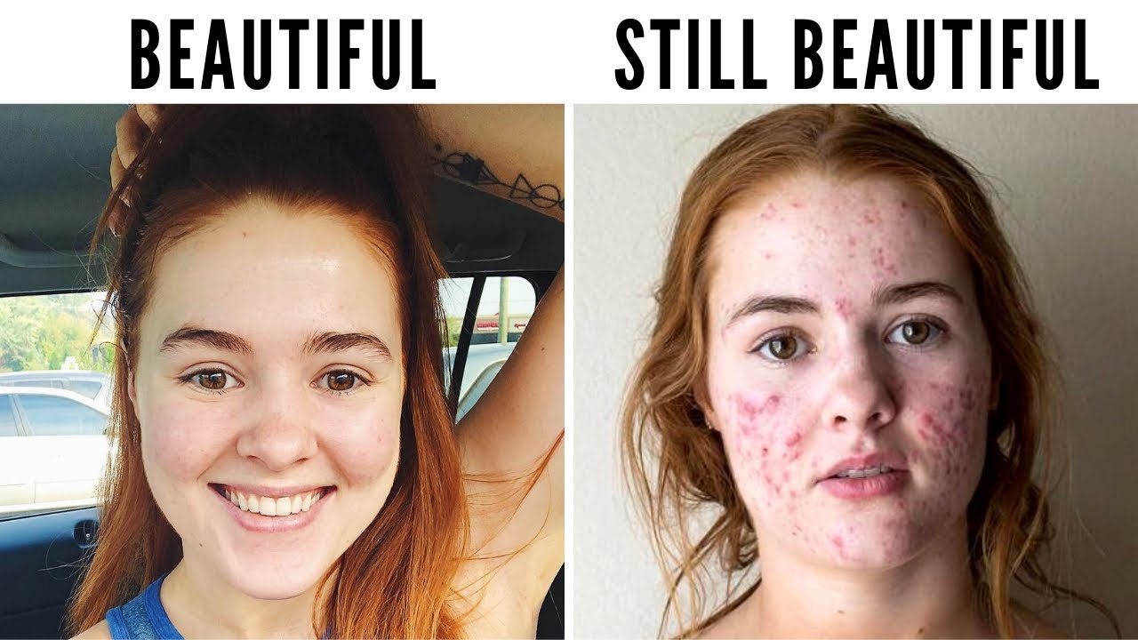 7 Tips On How To Stop Obsessing Over Acne