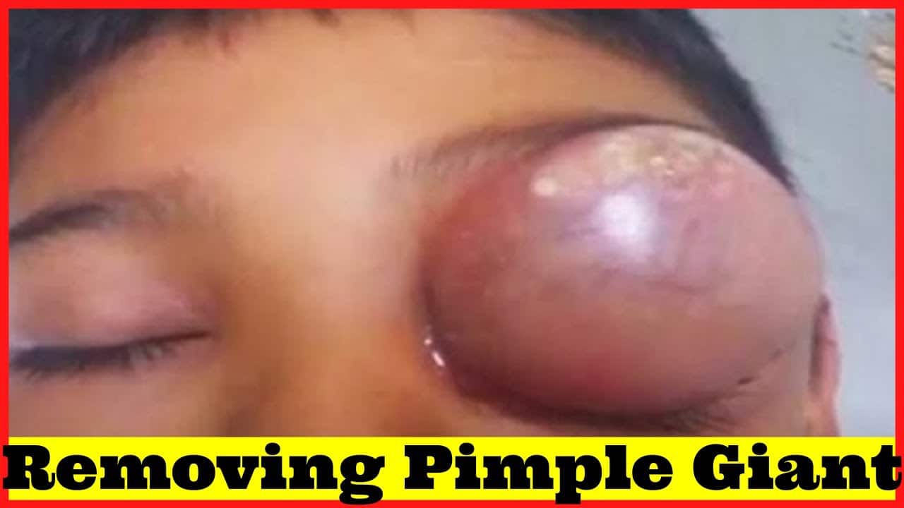 8 – Pimple Popping Compilation Most Popular Sebaceous Cyst Amazing Abscess On Nose of Poor little