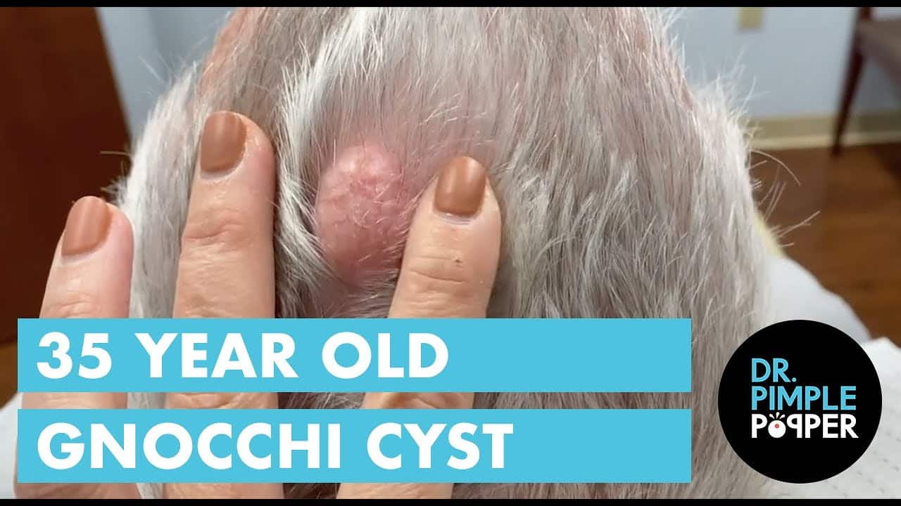 A 35 Year Old Gnocchi Pilar Cyst