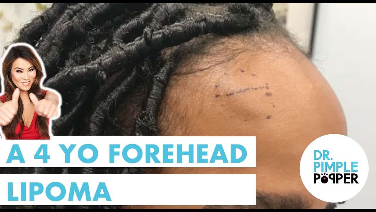 A 4 year old Forehead Lipoma