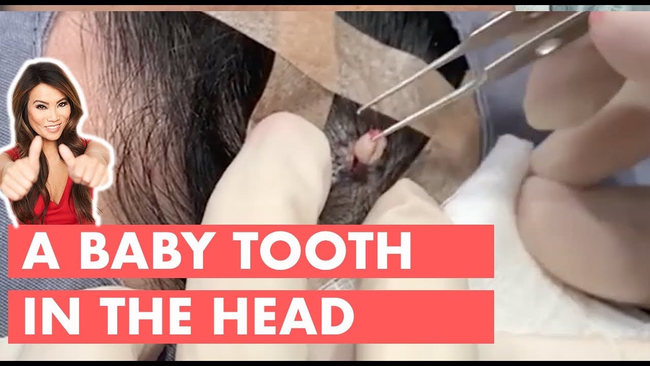 A Baby Tooth in the Head