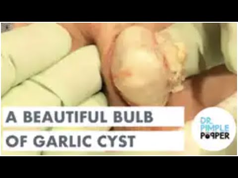 A Beautiful Bulb of Garlic Cyst